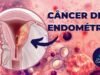 Cancer-de-Endometrio-1