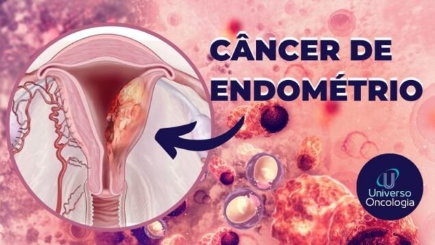 Cancer-de-Endometrio-1
