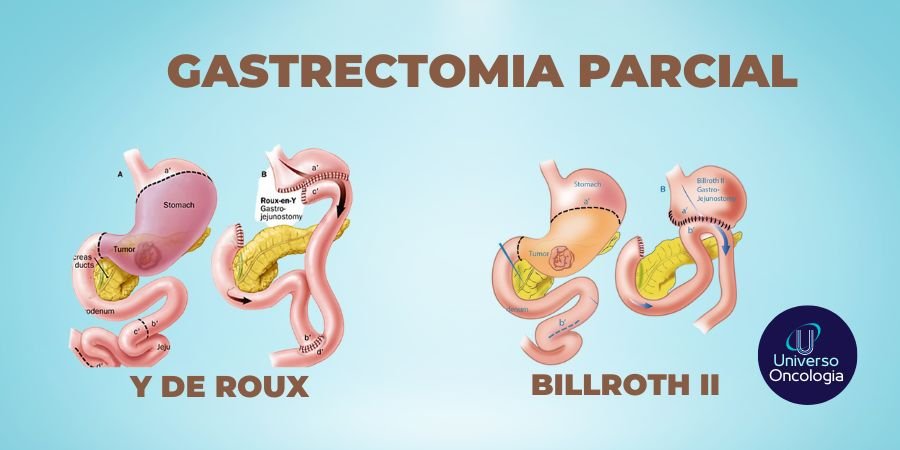 Gastrectomia: Como funciona o pré e pós-operatório? - CBCD