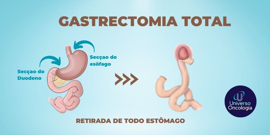 gastrectomias